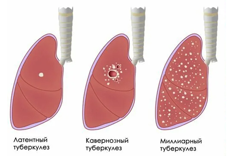 Основные разновидности туберкулеза легких