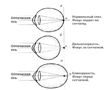Схематическое объяснение нарушения рефракции глаза
