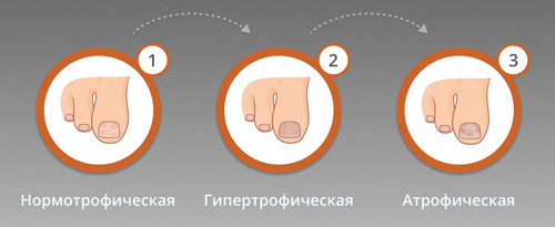 Стадии онихомикоза