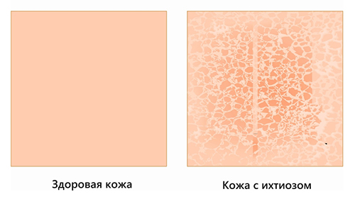 Сравнение здоровой кожи и кожи с ихтиозом Сравнение здоровой кожи и кожи с ихтиозом