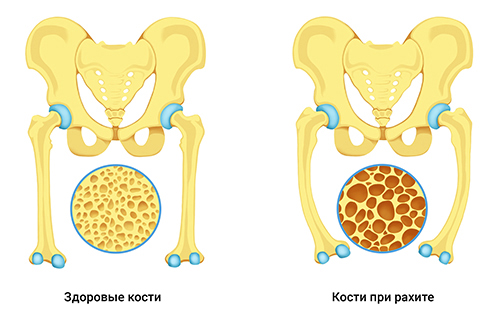 Сравнение здоровых костей и костей при рахите