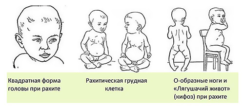 Признаки рахита у детей