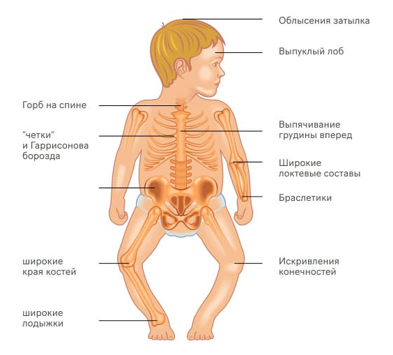 Симптомы рахита