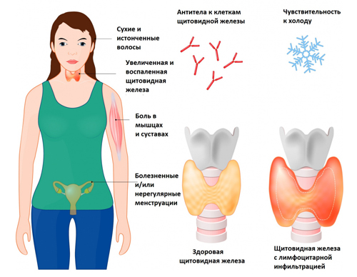 Симптомы аутоиммунного тиреоидита