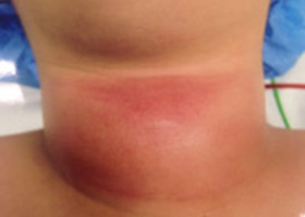 Тиреоидит острый