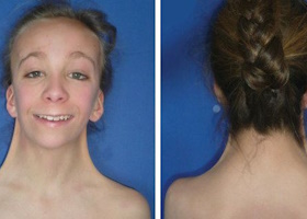 Синдром Шерешевского-Тернера