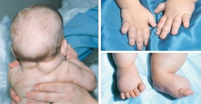 Синдром Шерешевского-Тернера Синдром Шерешевского-Тернера