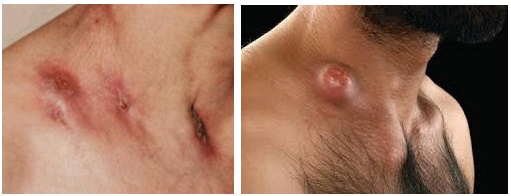 Свищи и рубцы при туберкулезе кожи