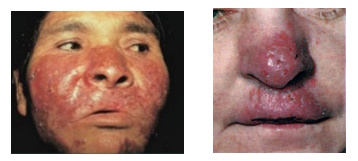 Туберкулез кожи на лице