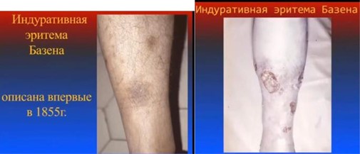Индуративная эритема Базена 