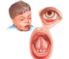 Возможно появление кровоизлияний в склеру и язвочек на уздечке языка