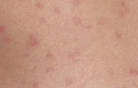 Розеолы — розовые пятна Розеолы — розовые пятна