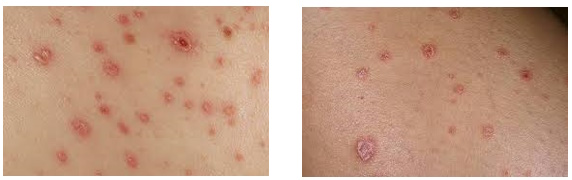 Вторичные сифилиды Вторичные сифилиды